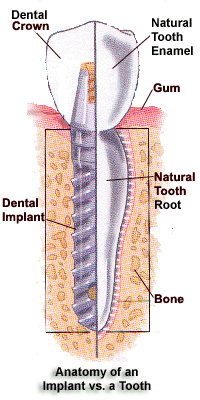 Boise Dentist Implant